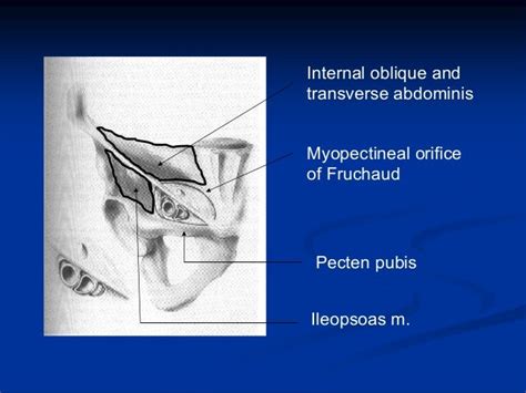 Cpd Hernia