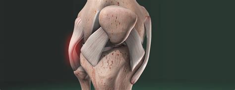 Knee Ligament Injuries NYC | MCL & LCL Tear Treatment in Manhattan