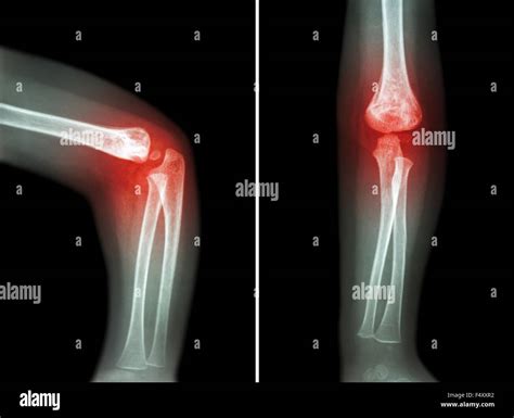 Rheumatoid arthritis , Gouty arthritis ( film x-ray child 's elbow Stock Photo: 89102246 - Alamy