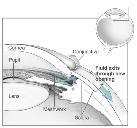 Glaucoma surgery - Wikipedia