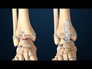 Ankle Fusion Surgery | Types | Risks | Cost