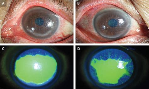 Sicca Syndrome With Keratoconjunctivitis - Pregnancy Informations