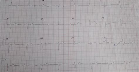 Cardiology window: Trifascicular block with sinus bradycardia