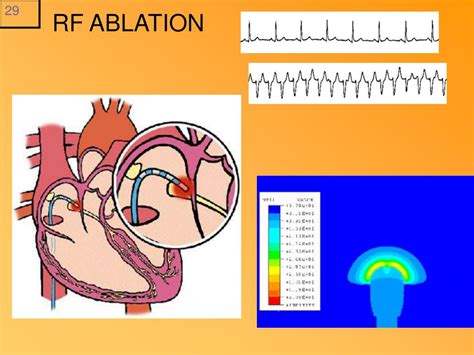 PPT - CORONARY ANGIO CARDIAC CATH & Ablation Procedures Lecture # 3 A ...