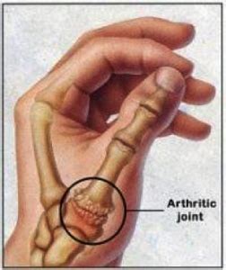 Hand Surgery Associates – CMC Joint