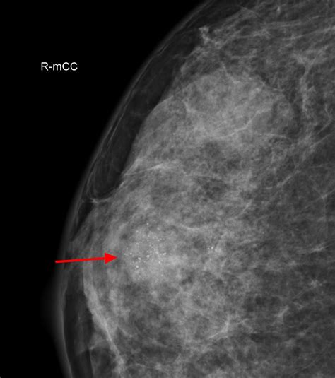 Fibroadenoma - Causes, Symptoms, Diagnosis, Treatment