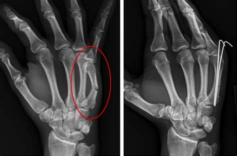 Hand Fracture - Raleigh Hand Surgery — Joseph J. Schreiber, MD