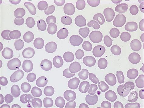 혈액종양내과 Hematology cell PBS 말초혈액도말검사 : 네이버 블로그