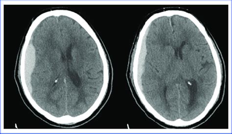 CT scan showing an acute subdural hematoma with mass effect and midline... | Download Scientific ...