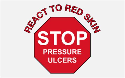 Stop the pressure! A simplified Guide to Pressure Ulcer Prevention and Pressure Ulcer Management ...