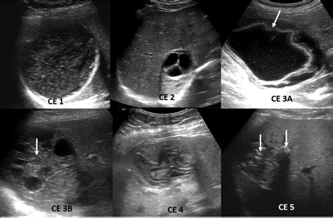 Hydatid cyst: Ultrasound. Multiple stages of hydatid cyst are shown.... | Download Scientific ...