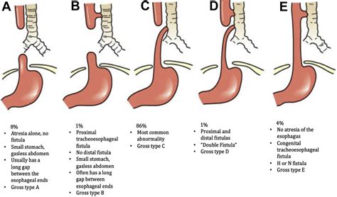 Advances in the Surgical Management of Esophageal Atresia - Advances in Pediatrics