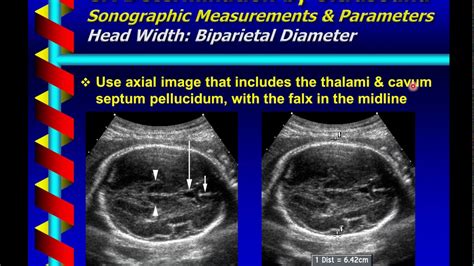 Gestational Age Determination by Ultrasound - YouTube