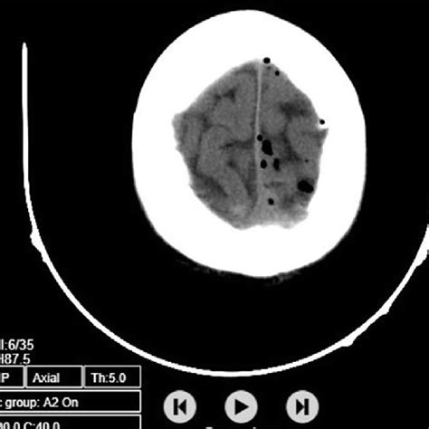 Intradural extramedullary enhancing tumor is noted at the 1st lumbar... | Download Scientific ...