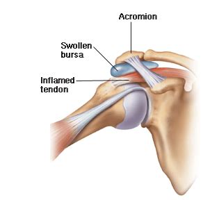 Shoulder Impingement and Subacromial Bursitis | Physiotherapy Manly