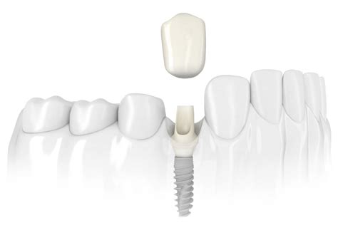 Single tooth replacement dental implants Moncton - Smiles Dental Docs