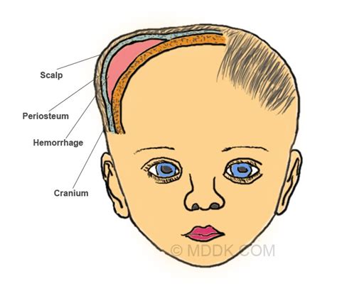 CEPHALOHEMATOMA VS SUBGALEAL HEMATOMA RADIOLOGY - Wroc?awski Informator Internetowy - Wroc?aw ...