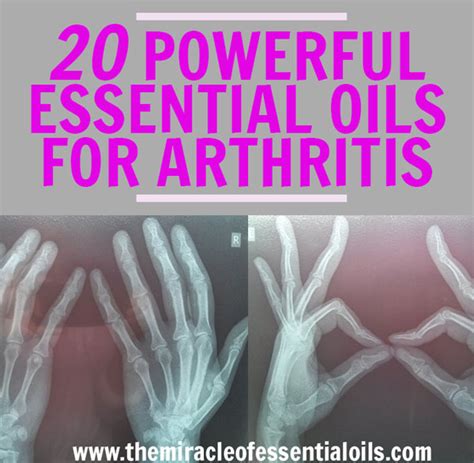 Top 20 Powerful Essential Oils for Arthritis Treatment - The Miracle of ...