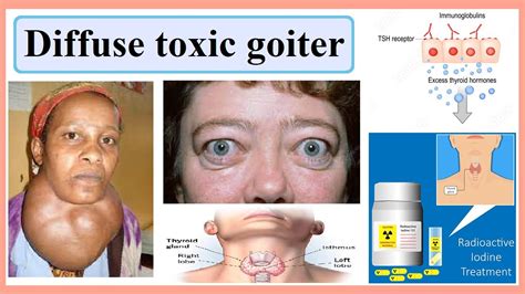 diffuse toxic goiter - YouTube