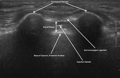 Transverse view of the sacral hiatus, showing sonographic image ...