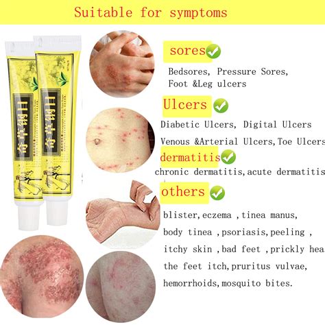 Buy 5pcs Lot Chinese Herbal Eczema, Psoriasis Cream,Eczema Cream ...