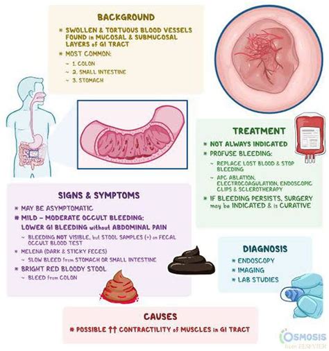 Angiodysplasia - MEDizzy