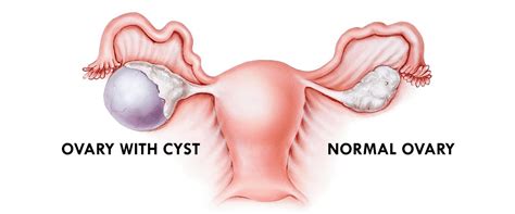 Cyst / Fibroid – Farmashealth