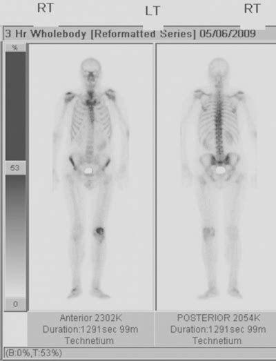 Bone Density Scan - Kymera Independent Physicians