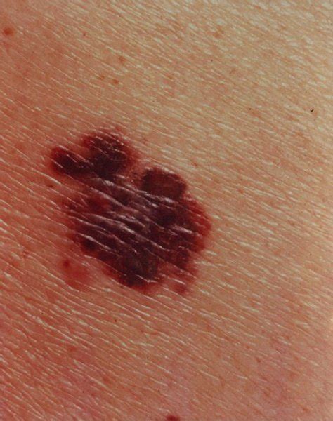 Melanoma: MedlinePlus Genetics