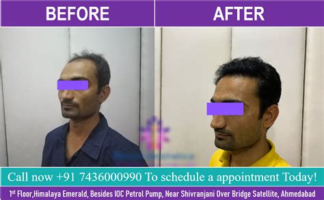 Best Hair Transplant Clinic in Ahmedabad