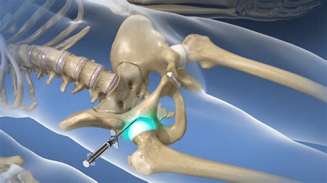 Hip Injections - Pain management clinics in Las Vegas | Nevada ...