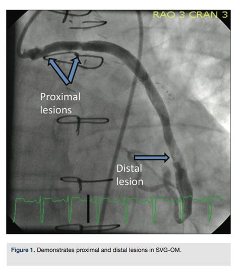 SVG to Circumflex Stenting with Significant Distal and Proximal Disease: A Complex Case ...