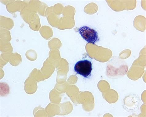 Leukocyte Alkaline Phosphatase Scoring - 5.