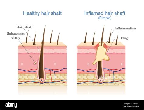 Disease hair Stock Vector Images - Alamy