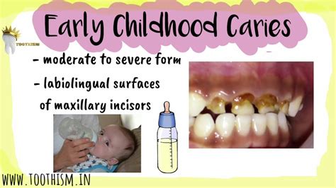 EARLY CHILDHOOD CARIES | Types of ECC | Prevention Levels, Management | ECC vs RAMPANT CARIES ...