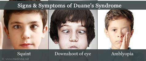 Duane Syndrome and Vision Training | AmblyoPlay