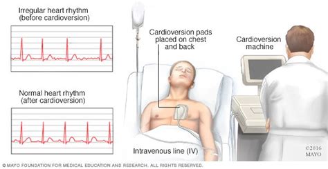 Cardioversion - Drugs.com