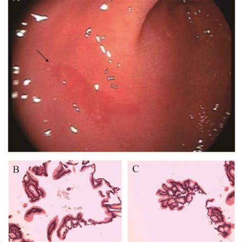 | (A) Electronic gastroscopy. (B,C) Gastric antrum pathology. | Download Scientific Diagram