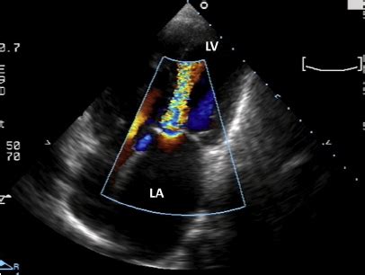 Color Doppler across mitral valve in a patient with mitral stenosis ...