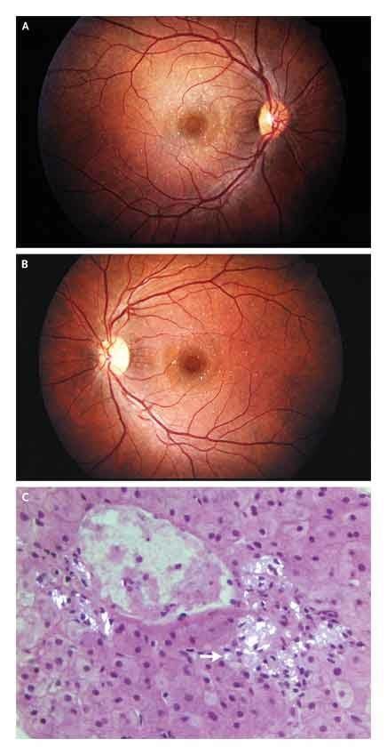 Talc Retinopathy | NEJM