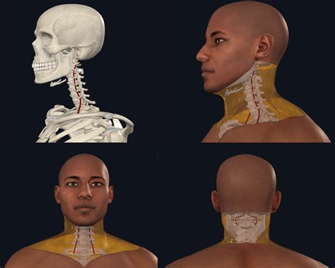 What is cervical artery dissection and how common is it, in ...