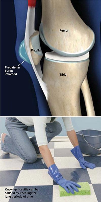 Bursitis Prepatelar (Bursitis de la Rodilla) | Grupo médico ortopédico de la costa central