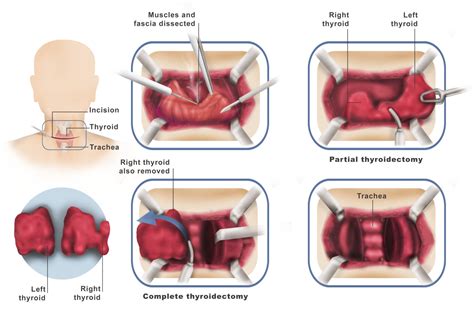 Thyroid and Parathyroid Surgery - Dr. Ahmed Farah Abdulrahman