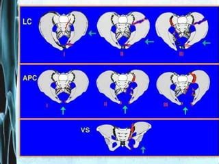 Classification Of Pelvic Fracture