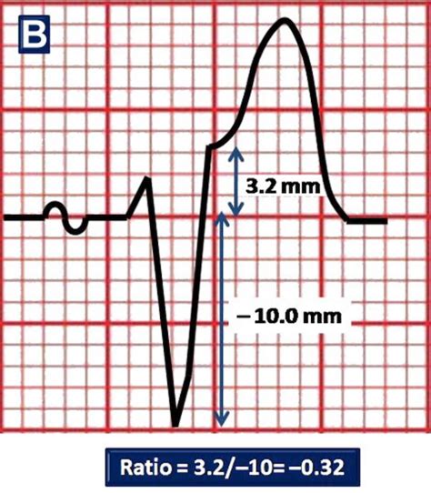 Enhancing Sgarbossa Criteria for STEMI — JournalFeed