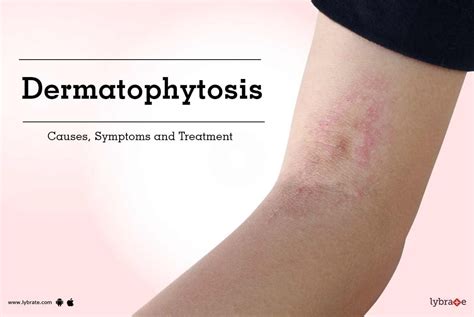 Dermatophytosis: Causes, Symptoms and Treatment - By Dr. Anshu Aggarwal ...