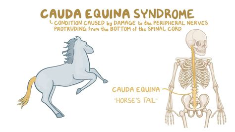 Spinal Cord Cauda Equina Conus Medullaris