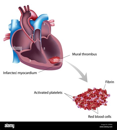 Ccs Guidelines Lv Thrombus | Paul Smith