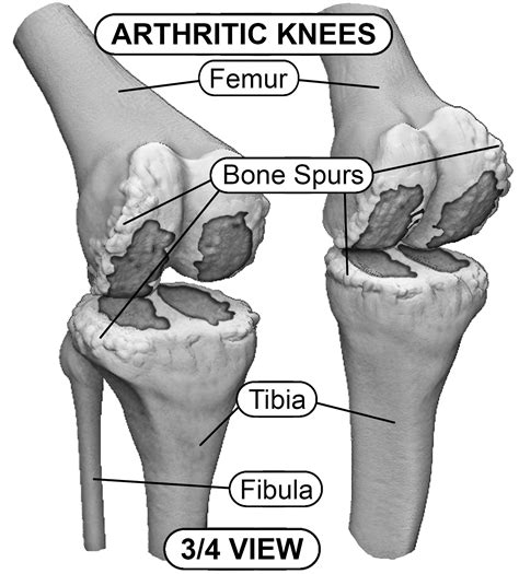 Bilateral knees with arthritis – Hip and Knee Handbook of Joint Replacement