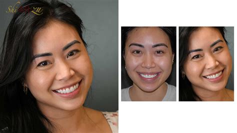 Transform your artificial-looking veneers into a genuinely natural smile